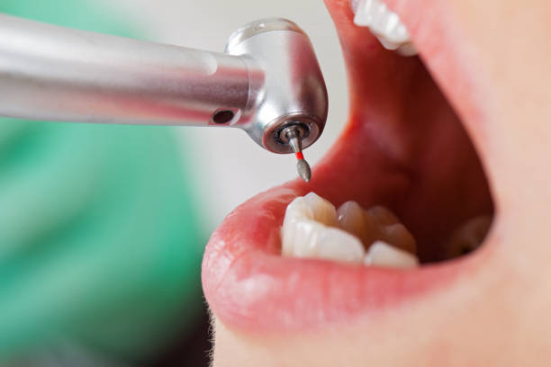 Best Emergency Root Canal Treatment in Fisher, IL